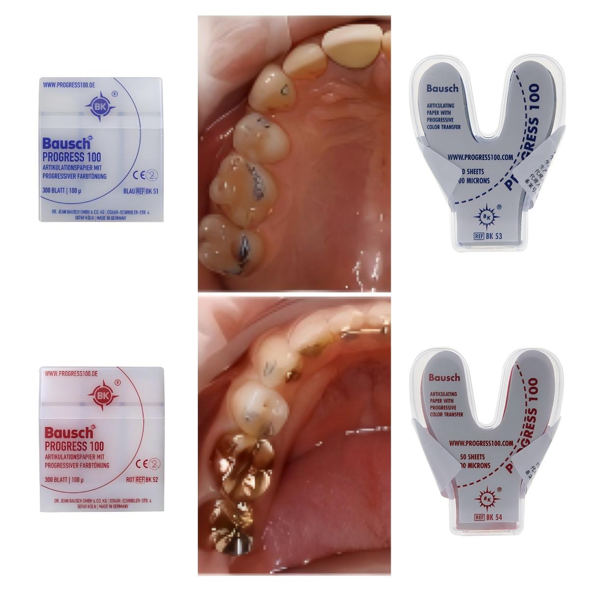 Bausch BK51 BK52 BK53 BK54 Den - Bite Indicator incelemesi ve fiyatı